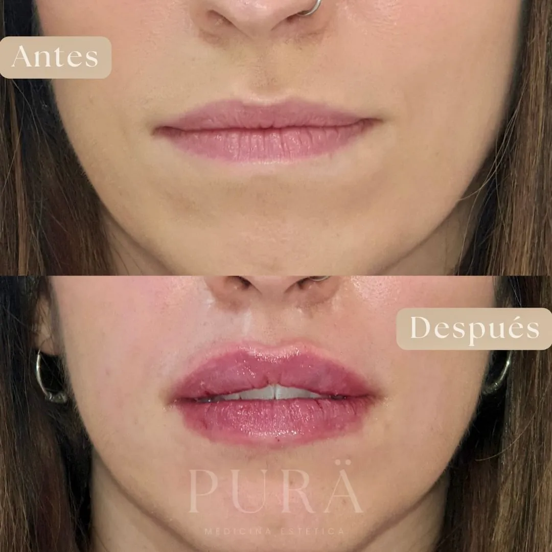 mejor aumento de labios con acido hialuronico en Málaga